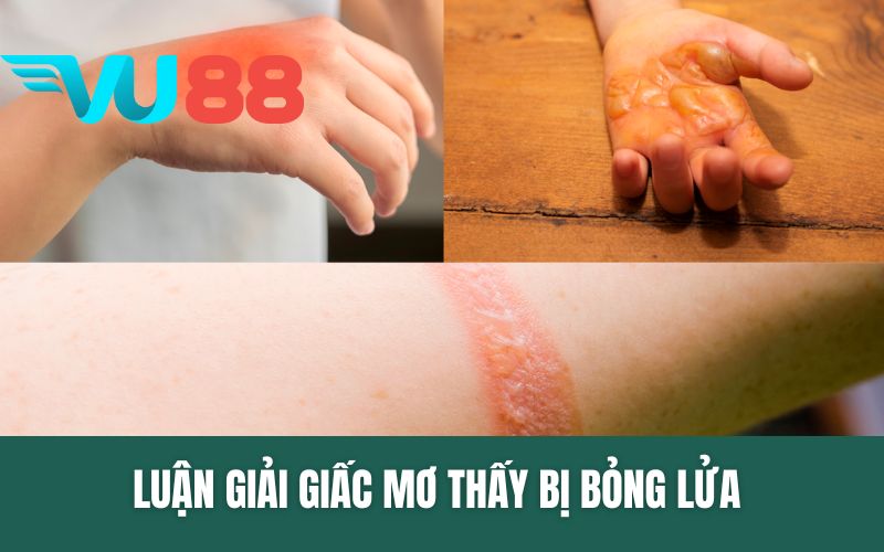 Luận Giải Giấc Mơ Thấy Bị Bỏng Lửa - Số Đề Bao Nhiêu?